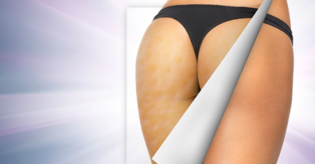 10 metode eficiente pentru a scapa de celulita definitiv