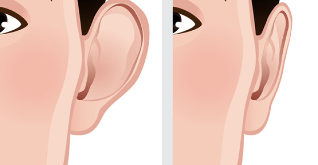 Otoplastia, singura operatie estetica ce se poate efectua din copilarie