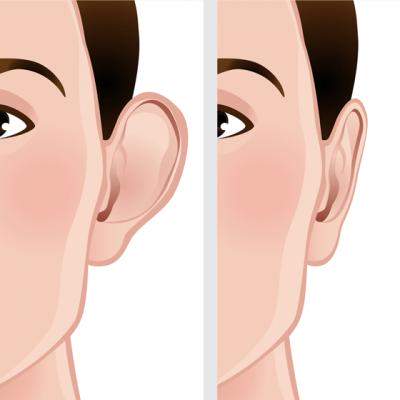 Otoplastia, singura operatie estetica ce se poate efectua din copilarie