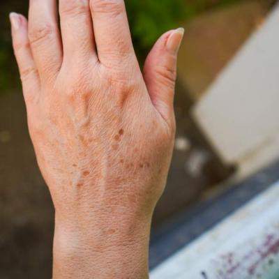 Pete pigmentare pe podul palmei? Tratamente naturiste care estompează blând mâinile pătate de soare și vârstă
