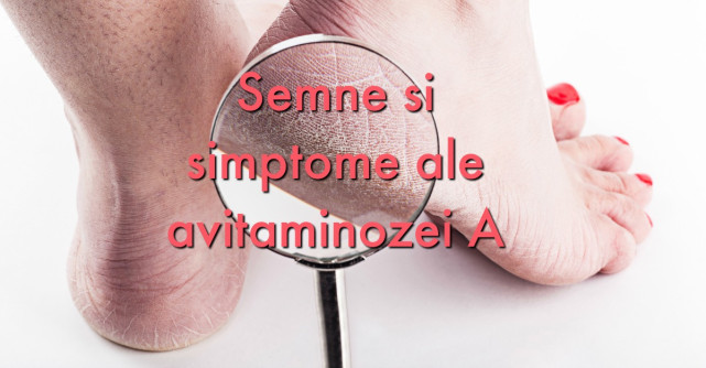5 Semne ca ai LIPSA de VITAMINA A