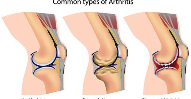 GONARTROZA: cauza a durerilor si deformarilor genunchilor