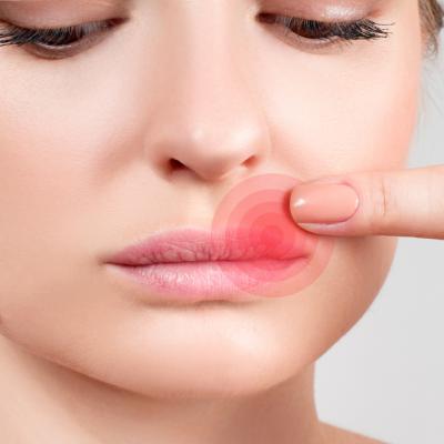 Herpes oral la adulți – tratament, prevenție și remedii