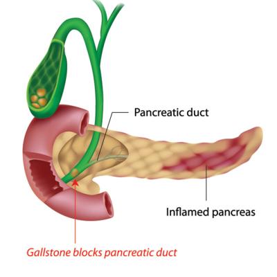 De ce facem PIETRE LA FIERE?
