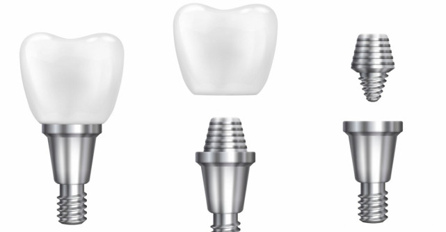 Implant dentar Straumann: de ce este considerat o soluție premium pentru dinții pierduți
