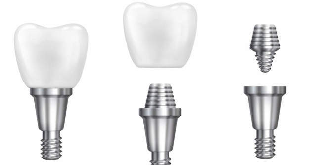 Implant dentar Straumann: de ce este considerat o soluție premium pentru dinții pierduți