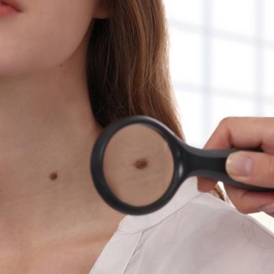 Formula ABCDE pentru alunițe sau cum știi când trebuie să mergi la medic