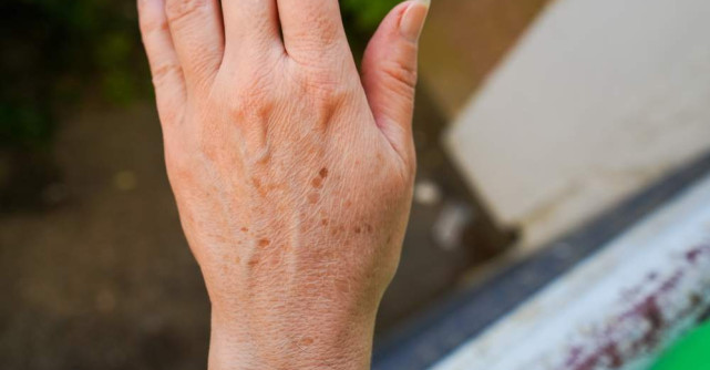 Pete pigmentare pe podul palmei? Tratamente naturiste care estompează blând mâinile pătate de soare și vârstă