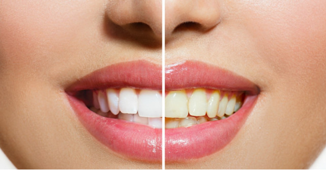 5 cauze ale ingalbenirii dintilor. Cum le poti trata acasa, in mod natural si fara efort