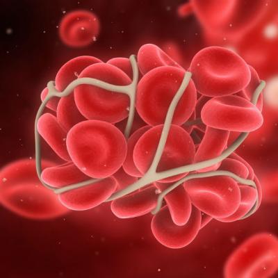 TEV - a treia boala cardiovasculara ca incidenta