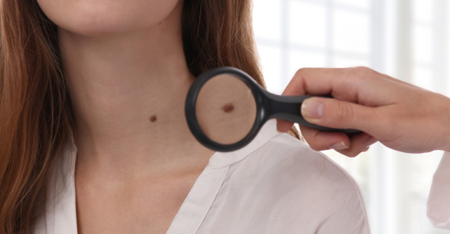 Când ar trebui să te îngrijoreze o aluniță? Semnale de alarmă pe care nu trebuie să le ignori