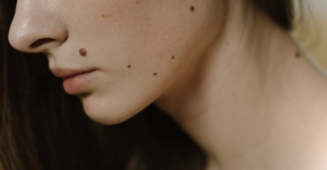 Ce secret incredibil pot dezvălui alunițele tale? Ai o aluniță pe gât, spate sau buze? Află ce destin îți este scris pe piele