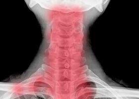 Spondiloza cervicala: cauza ametelilor si a furnicaturilor in brate