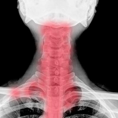 Spondiloza cervicala: cauza ametelilor si a furnicaturilor in brate