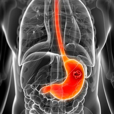 Analize medicale pentru ULCERUL GASTRIC