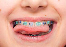 Aparatele dentare la copii: moft sau necesitate medicală? Ce spun studiile și practica ortodontică