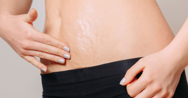 Cum previi sau atenuezi inesteticele vergeturi?