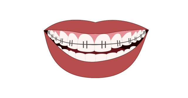 Ce facem daca purtam aparat dentar in perioada de izolare la domiciliu?