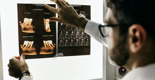 Măseaua de minte și povestea ei delicată