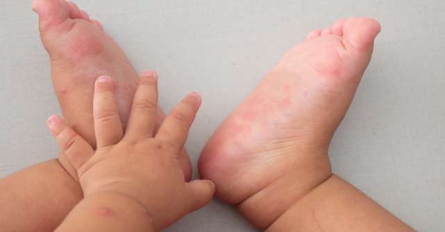 Boala gură-mână-picior: cauze, simptome și tratament