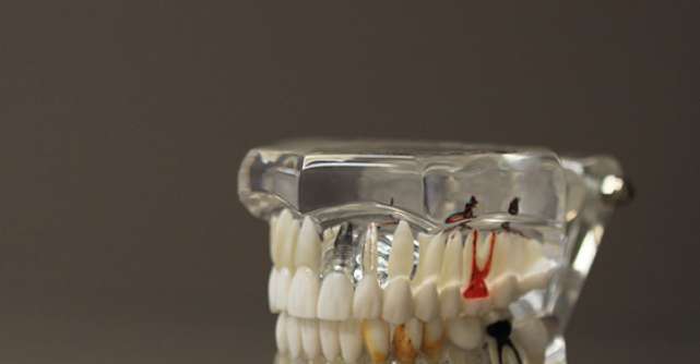 Protezele dentare second hand – o gluma proasta?