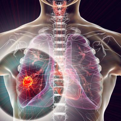 Cancerul pulmonar: ce ar trebui să știm și de ce este important să fim informați