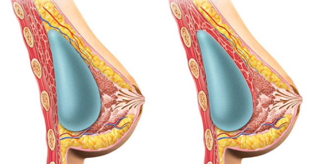 Ce crede lumea despre marirea sanilor si care este adevarul