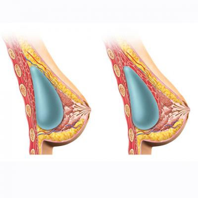 Ce crede lumea despre marirea sanilor si care este adevarul