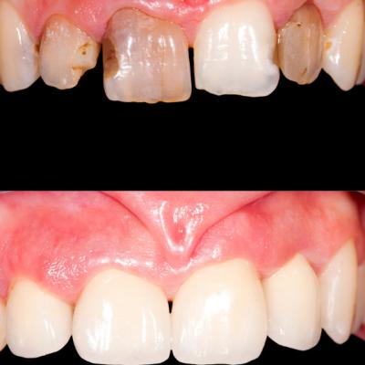 Folosirea laserului versus utilizarea metodei clasice pentru tratarea bolilor parodontale