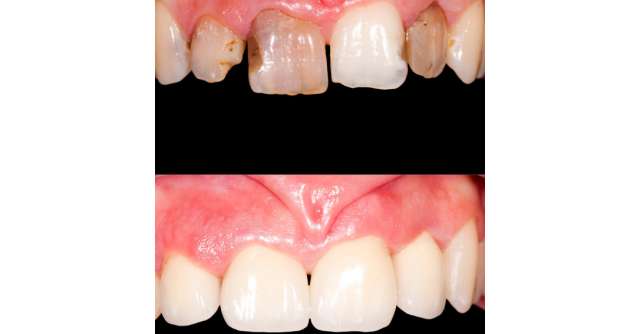 Folosirea laserului versus utilizarea metodei clasice pentru tratarea bolilor parodontale