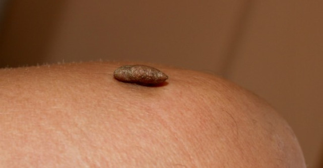 4 Metode de tratament al negilor - inclusiv pentru negii genitali