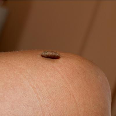 4 Metode de tratament al negilor - inclusiv pentru negii genitali