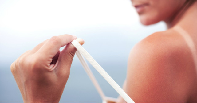 Arsuri solare: simptome, tratament si ce consecinte grave pot aparea