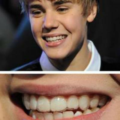 (P) Dinti strambi? Zambeste! A aparut aparatul dentar INVIZIBIL!