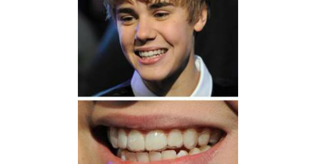 (P) Dinti strambi? Zambeste! A aparut aparatul dentar INVIZIBIL!