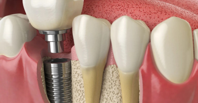 7 semne că ai nevoie de un implant dentar și nu de o punte