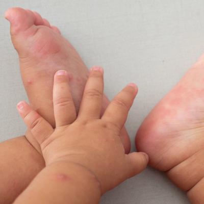 Ce nu stiai despre boala gura mana picior: simptome, cauze, tratament si cum poate fi prevenita