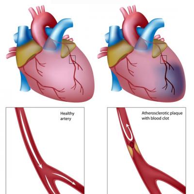 Elixirul din STRABUNI care te scapa de boala de INIMA