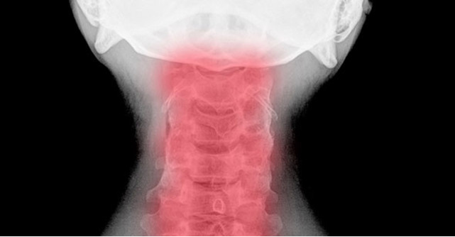 Spondiloza cervicala: cauza ametelilor si a furnicaturilor in brate