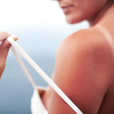 Arsuri solare: simptome, tratament si ce consecinte grave pot aparea