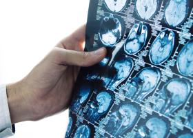 Avantajele intervențiilor de neuroradiologie intervențională: tratamente minim invazive pentru afecțiuni cerebrale și spinale