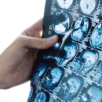 Avantajele intervențiilor de neuroradiologie intervențională: tratamente minim invazive pentru afecțiuni cerebrale și spinale 