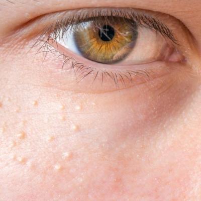 Punctele de grăsime de pe față – de ce apar și cum scăpăm de ele