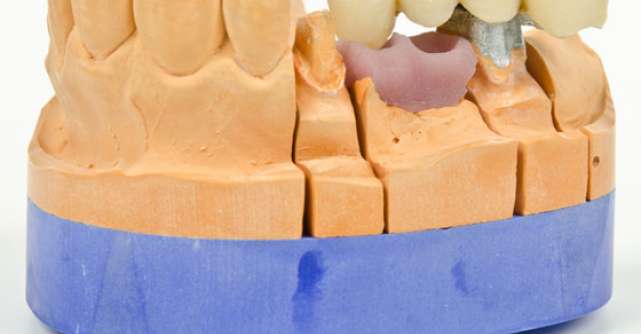 AJUTOR - 5 Cauze care pot duce la pierderea dintilor!