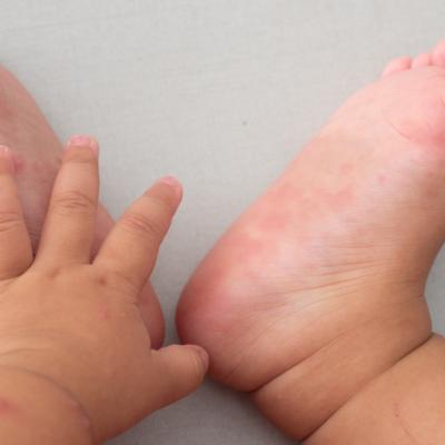 Boala gură-mână-picior: cauze, simptome și tratament