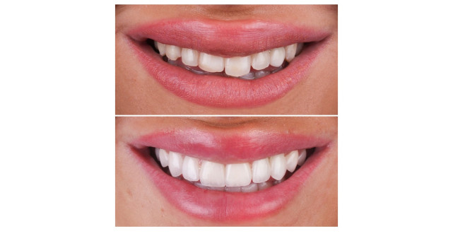  Noul curent de personalizare a zâmbetului pentru pacienții din România