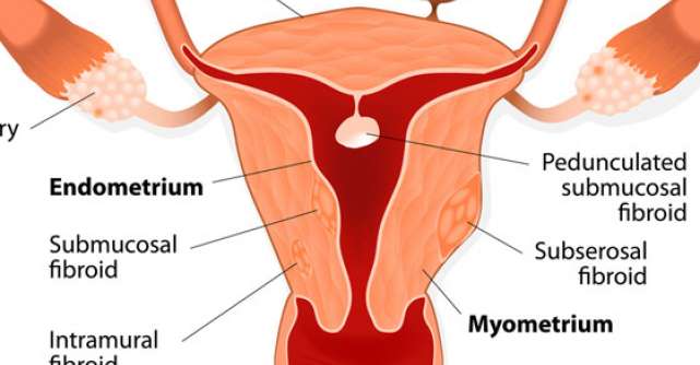 Fibromul uterin - tratat prin Laparoscopie