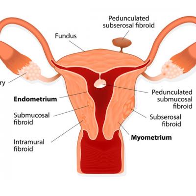 Fibromul uterin - tratat prin Laparoscopie