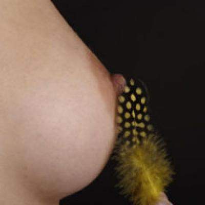 Mamoplastia - intre estetic si necesar