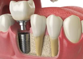 7 semne că ai nevoie de un implant dentar și nu de o punte